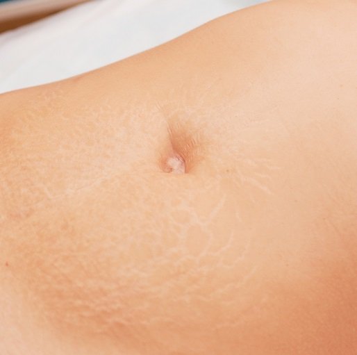stretchmarks_tips