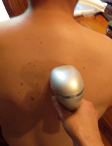 home IPL Treatments