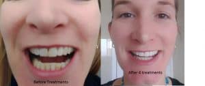  teeth whitening kit review