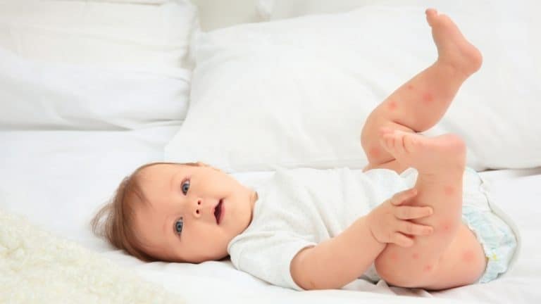 Top 5 Best Cream for Baby Eczema Australia