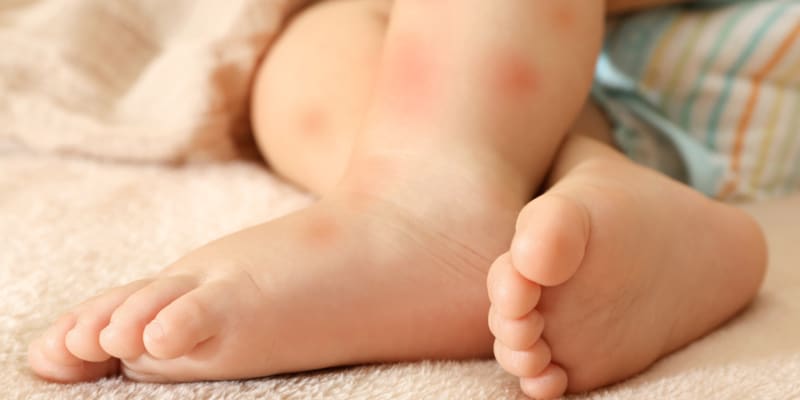 close up photo of eczema on baby's legs