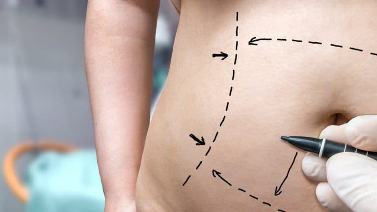 Abdominoplasty