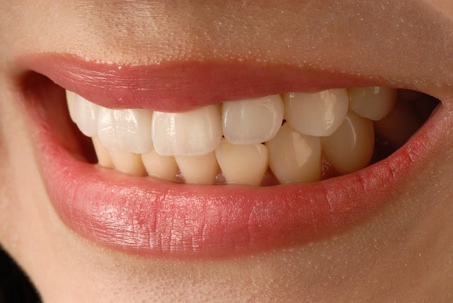 Smiling mouth of woman showing dental veneers