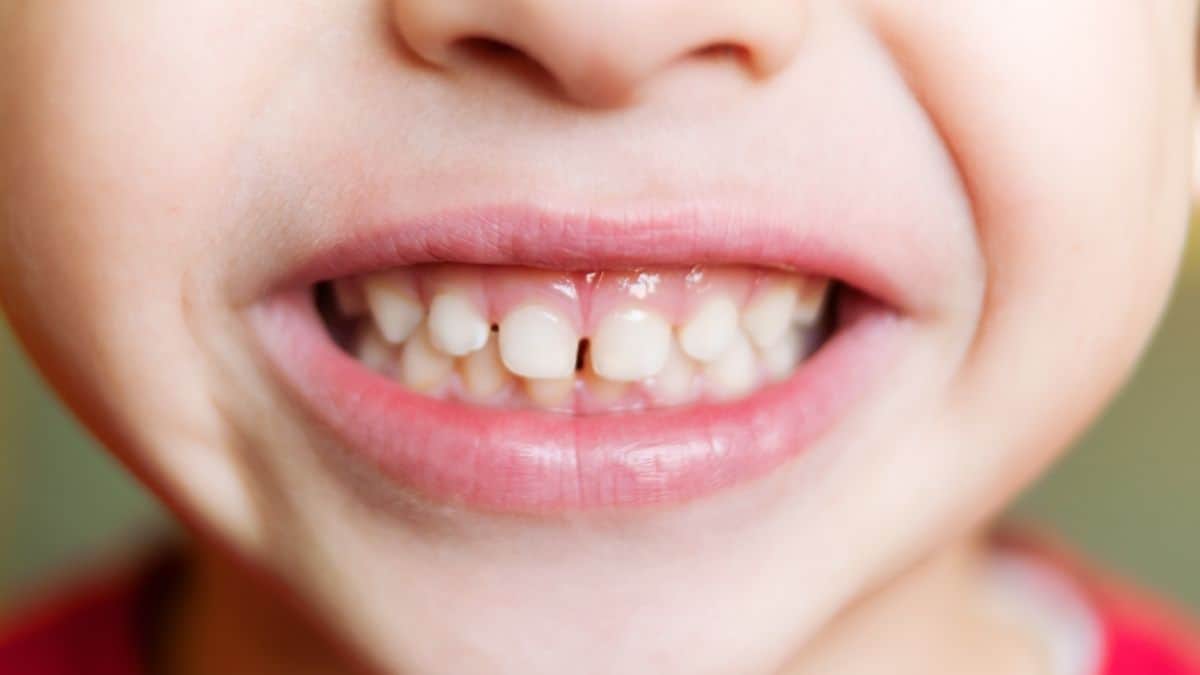 4 Ways to Help Deal with Teeth Grinding