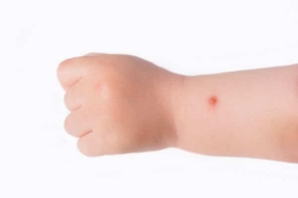 mosquito bite baby arm