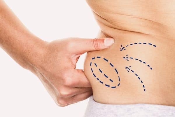 Liposuction Lines On Waist