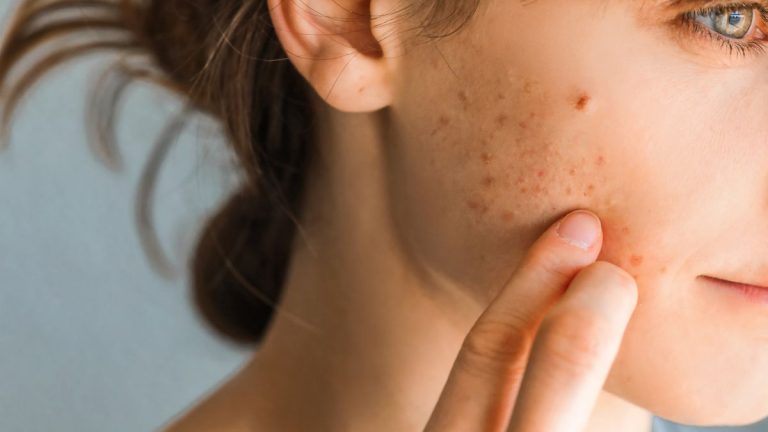 What To Know About Adult Acne