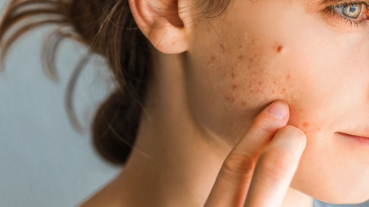 What To Know About Adult Acne