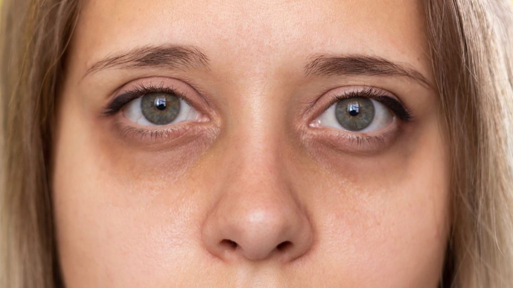 Under Eye Filler